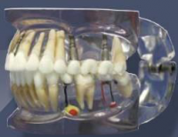 MDO-43 Transparentní model horní a dolní čelisti s fixní protézou na implantátu
